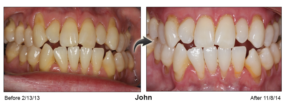 south carolina gum recession